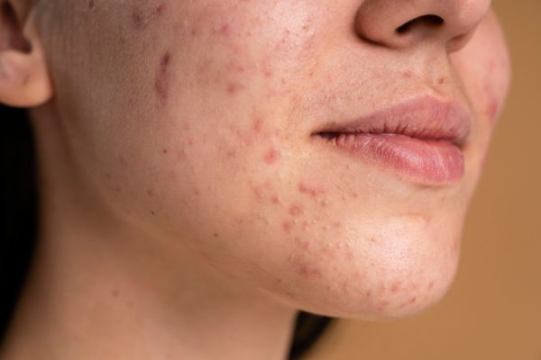 Productos para Pieles Grasas o Propensas al Acné - Dermocosmética Sa Farmacia